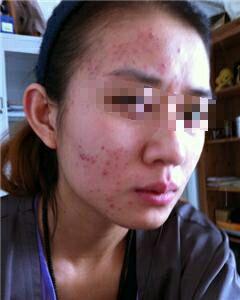 臉上長痘痘怎么能快速消除，全面解析與應(yīng)對方法，全面解析，快速消除臉部痘痘的應(yīng)對方法與策略