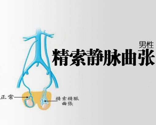 精索靜脈曲張的癥狀表現(xiàn)及其影響，精索靜脈曲張的癥狀表現(xiàn)及其潛在影響