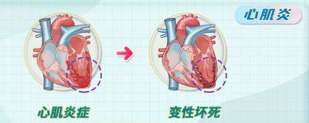 女性心肌炎的癥狀表現(xiàn)及其重要性，了解、預(yù)防與治療，女性心肌炎的癥狀、重要性，了解、預(yù)防與治療全攻略
