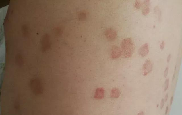 皮膚癬初期圖片及識(shí)別指南，皮膚癬初期癥狀圖片與識(shí)別指南