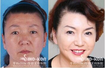 美容去皺紋針的價(jià)格，了解一針的價(jià)格及更多細(xì)節(jié)，美容去皺針價(jià)格解析，一針的價(jià)格及更多細(xì)節(jié)揭秘