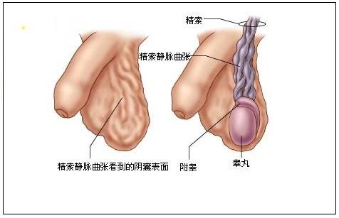 精索靜脈曲張，了解、預防與治療，精索靜脈曲張，全面解析了解、預防與治療策略