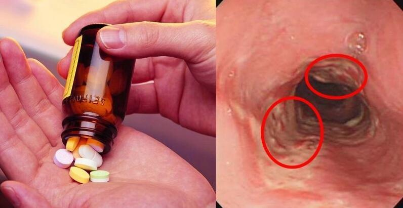 食道炎與食道癌，最明顯的區(qū)別解析，食道炎與食道癌，顯著區(qū)別解析