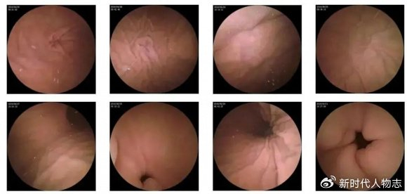 肛門息肉早期圖片及其相關(guān)介紹，肛門息肉早期圖片與詳細(xì)介紹