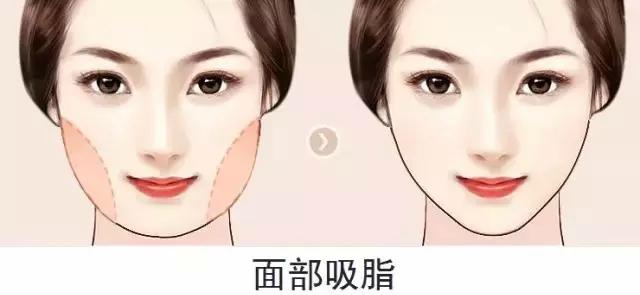 吸脂手術(shù)，是否會(huì)反彈及副作用解析，吸脂手術(shù)解析，反彈風(fēng)險(xiǎn)與副作用探討