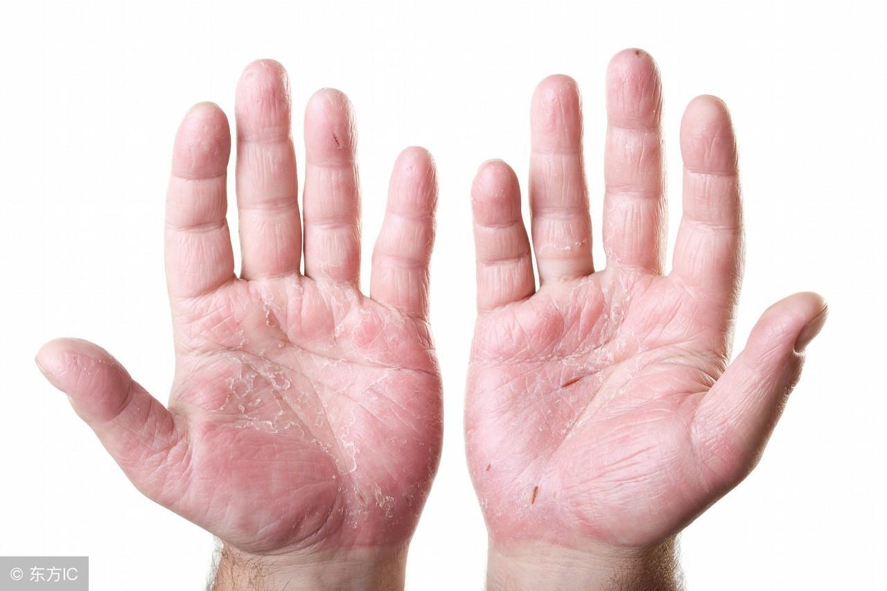 濕疹怎么治療，全面解析有效的治療方法，全面解析濕疹的有效治療方法