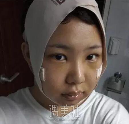 磨骨一年后的驚人變化，對比照片揭示細(xì)節(jié)，磨骨一年后的驚人變化，細(xì)節(jié)對比揭示驚人效果