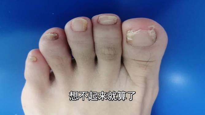 灰指甲由輕到重的圖片展示與解析，灰指甲病情進(jìn)展圖片展示及解析