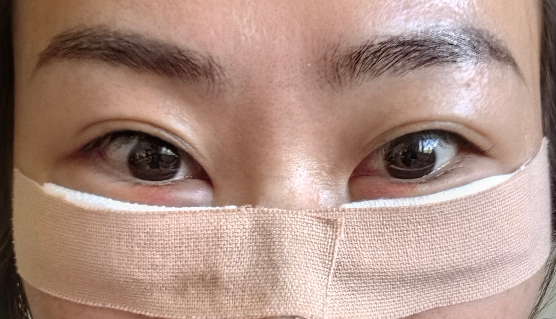 眼袋手術(shù)，重塑眼部魅力，重拾自信光彩，眼袋手術(shù)重塑眼部魅力，重拾自信亮眼光彩