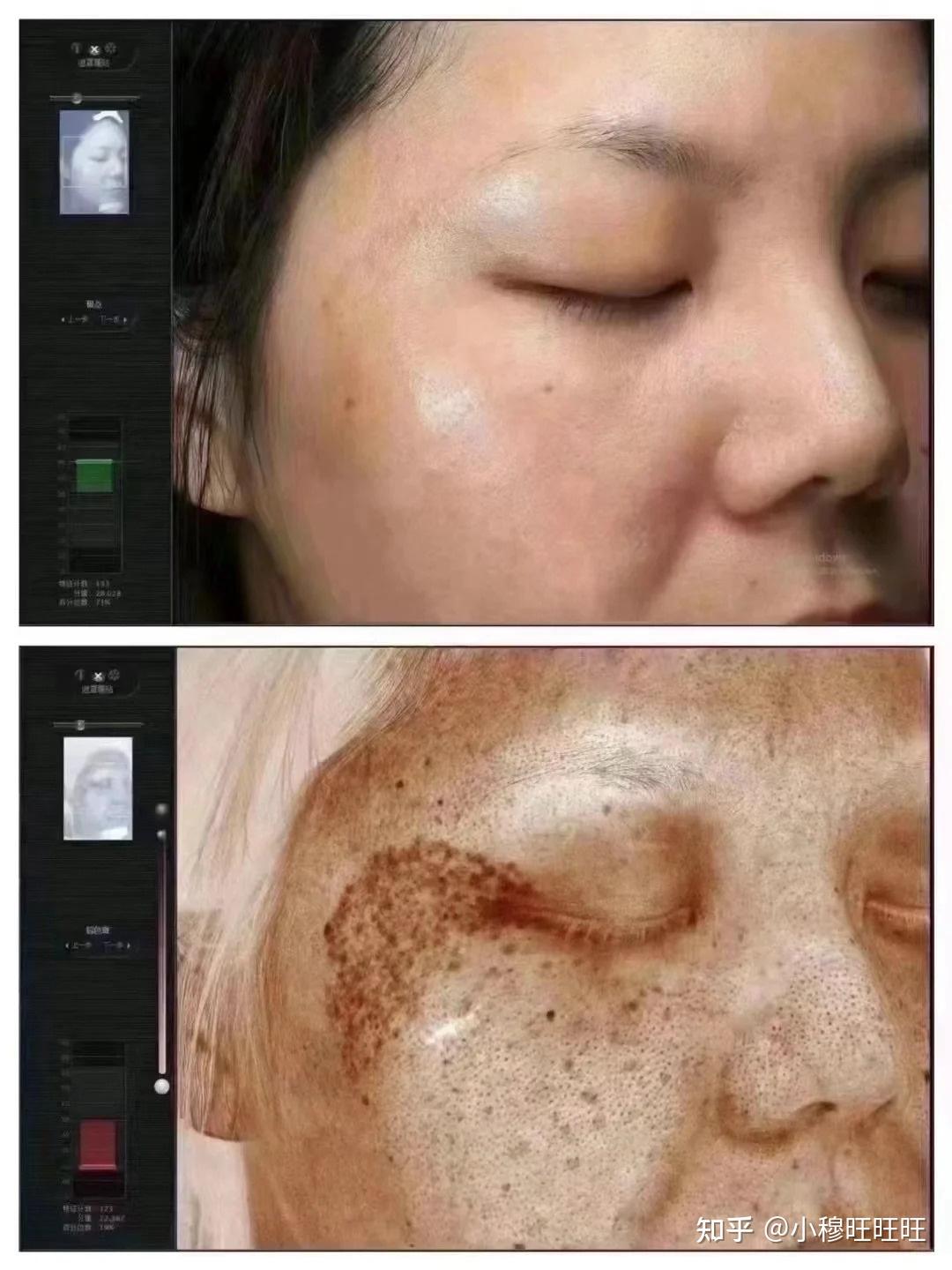 激光祛斑，選擇醫(yī)院還是美容院？全面解讀助您做出明智決策，激光祛斑，如何選擇醫(yī)院與美容院？全面解讀為您指明決策方向