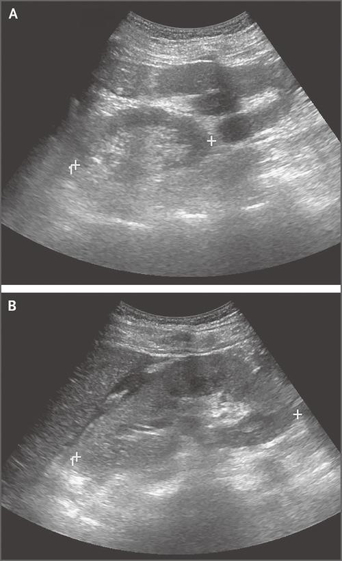 闌尾炎最佳治療方法，闌尾炎最佳治療方法詳解