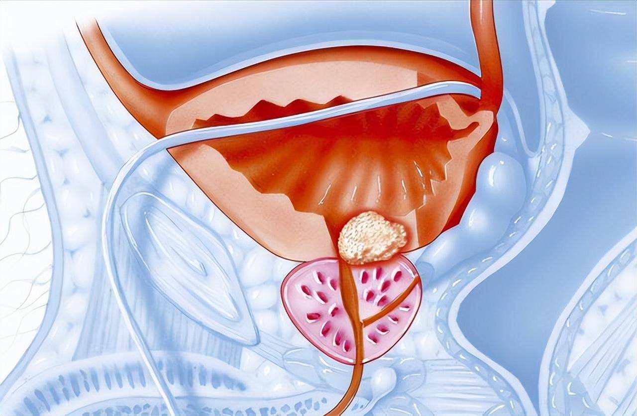 前列腺炎拖久了會怎樣，前列腺炎拖久了的后果，嚴重并發(fā)癥與影響生活質量
