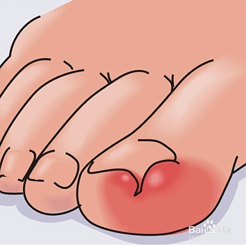 如何應對腳趾甲長到肉里的問題——全方位解決方案，全方位解決方案，應對腳趾甲長到肉里的困擾與挑戰(zhàn)