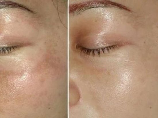 揭秘皮秒美容真相，380元一次的皮秒激光是真還是假？，皮秒美容真相揭秘，皮秒激光的真假與價格背后的秘密探究