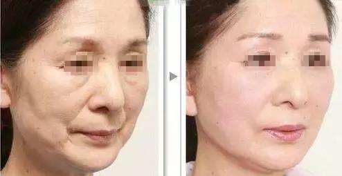 全面解析痤瘡皮膚，成因、治療與護(hù)理，全面解析痤瘡皮膚，成因、治療與護(hù)理指南