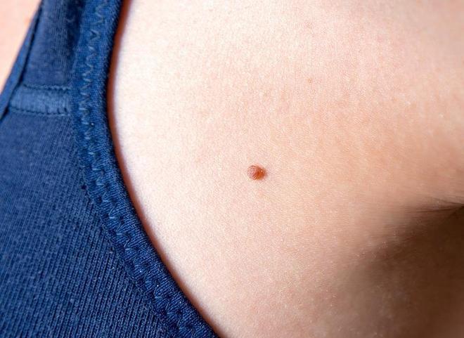 一圖教你識別皮贅和絲狀疣，皮贅與絲狀疣識別指南，圖解區(qū)分方法