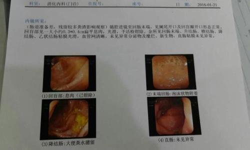 如何判斷痔瘡還是息肉，癥狀、診斷與治療方法，痔瘡與息肉，癥狀、診斷及治療方法詳解