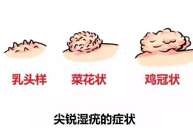 尖銳濕疣與艾滋病，并非必然的前兆關聯(lián)，尖銳濕疣與艾滋病，非必然前兆關聯(lián)探討