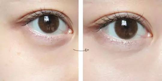 黑眼圈的治療方法，快速有效的解決方案，黑眼圈消除秘籍，快速有效的治療方法分享