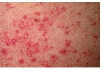 濕疹的七天演變過(guò)程圖片詳解，濕疹七天演變過(guò)程圖解，了解濕疹的演變之路