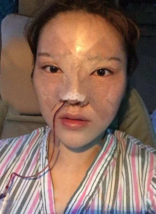 玻尿酸打完幾天最好看，恢復時間與效果解析，玻尿酸注射后的最佳效果時間與恢復時間解析