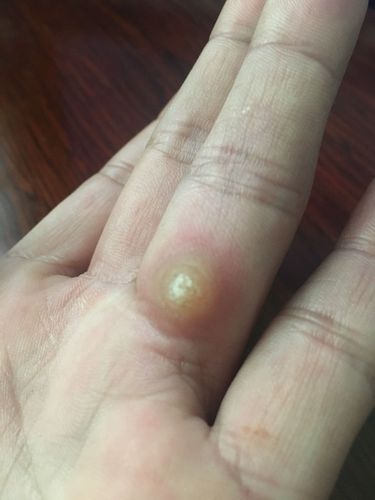手上長雞眼初期圖片，了解、預(yù)防與治療，手上長雞眼，初期圖片、預(yù)防與治療方法全解析