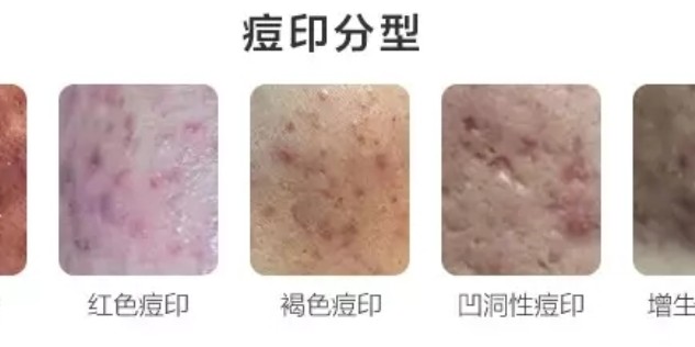 怎樣去痘印效果最好的方法，揭秘最佳去痘印方法，告別臉部瑕疵！