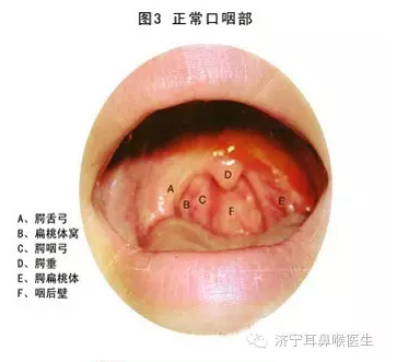 慢性咽炎三天斷根，真相還是幻想？，慢性咽炎三天斷根，真相還是幻想？揭秘治療真相。