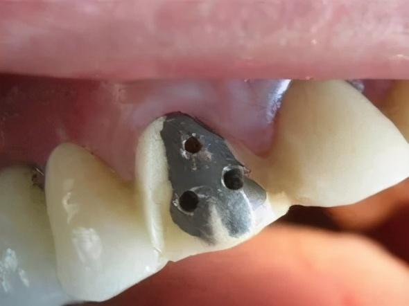 全瓷牙價(jià)格解析，多少錢一顆？，全瓷牙價(jià)格詳解，每顆價(jià)格究竟多少？