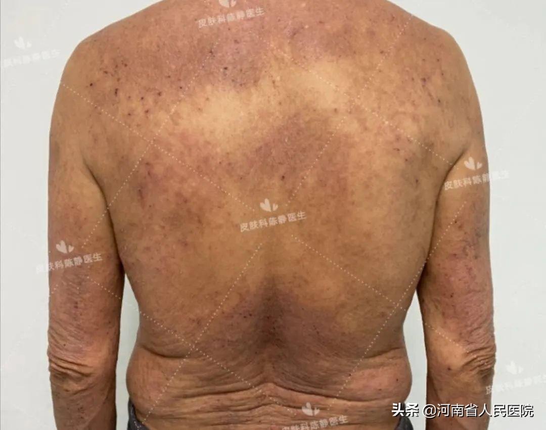 濕疹的樣子圖片，深入了解濕疹癥狀與表現(xiàn)，濕疹癥狀與表現(xiàn)詳解，圖片展示，助你深入了解濕疹特征