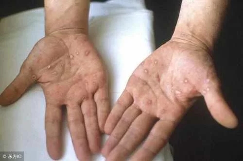 男人得梅毒的六個(gè)前兆，了解并預(yù)防梅毒癥狀，男人得梅毒的六個(gè)前兆，如何預(yù)防梅毒癥狀的出現(xiàn)