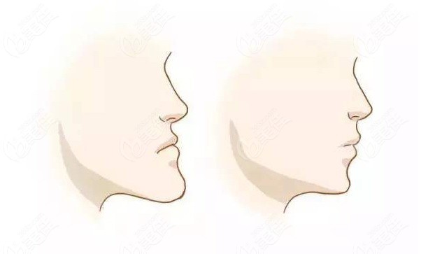 做正頜手術(shù)的最佳年齡，了解與選擇最佳時(shí)機(jī)，正頜手術(shù)的最佳年齡選擇與時(shí)機(jī)選擇指南