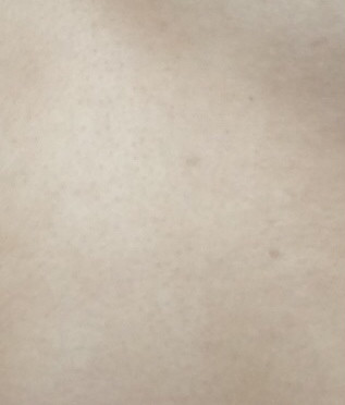 身上長紅色點(diǎn)點(diǎn)是怎么回事？全面解析皮膚異常現(xiàn)象，皮膚異?，F(xiàn)象解析，身上長紅色點(diǎn)點(diǎn)的可能原因與解析