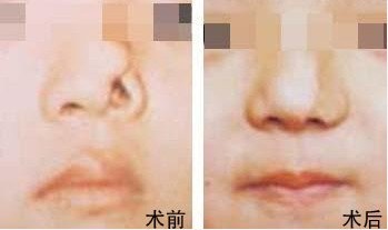 鼻整形手術(shù)費用詳解，多少錢？一切因素告訴你！，鼻整形手術(shù)費用全面解析，價格因素一網(wǎng)打盡！