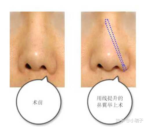 縮小鼻翼的方法，有效改善鼻翼過(guò)大的實(shí)用指南，縮小鼻翼的有效方法，實(shí)用指南助你改善鼻翼過(guò)大問(wèn)題