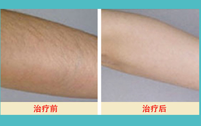 激光脫毛的價(jià)格解析，多少錢(qián)才能擁有絲滑肌膚？，激光脫毛價(jià)格詳解，多少錢(qián)能擁有絲滑肌膚？