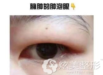 腫眼泡抽脂手術(shù)費(fèi)用詳解，多少錢？，腫眼泡抽脂手術(shù)費(fèi)用解析，手術(shù)費(fèi)用究竟是多少？