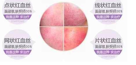 淡化紅血絲的小竅門，實(shí)用方法與日常護(hù)理建議，淡化紅血絲的小妙招，實(shí)用方法與日常護(hù)理建議