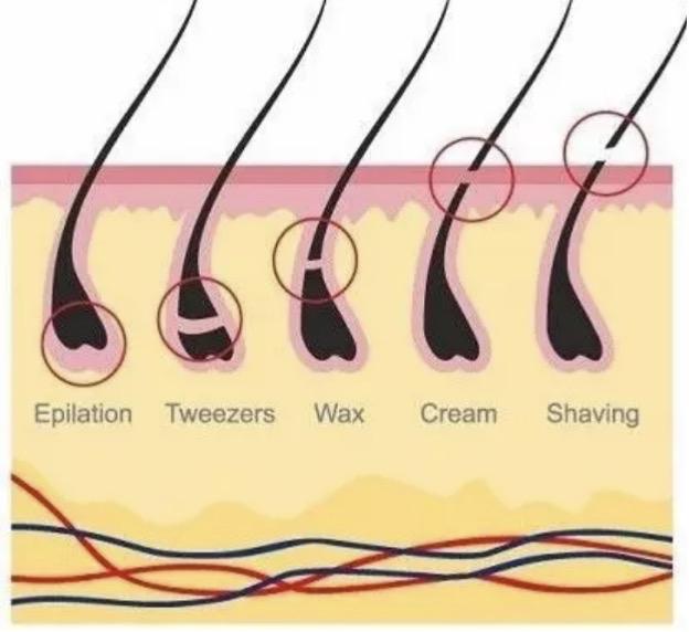 關于去醫(yī)院脫毛的價格解析，費用因素與大致預算，醫(yī)院脫毛價格詳解，費用因素與預算指南